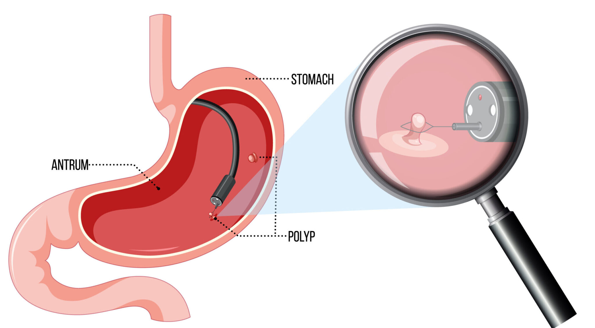 endoscopy